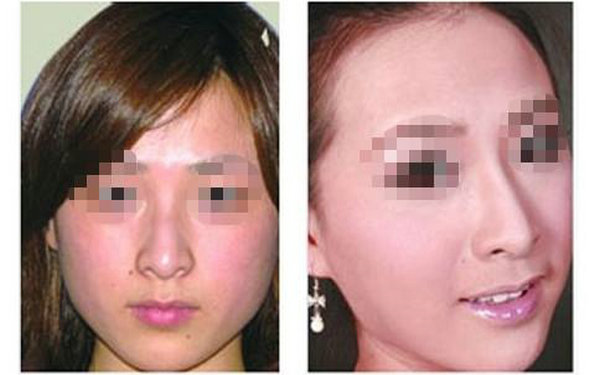 哪些人不適合硅膠<a href=http://www.sbs17.com/listinfo-737-0.html target=_blank class=infotextkey>隆鼻</a>?