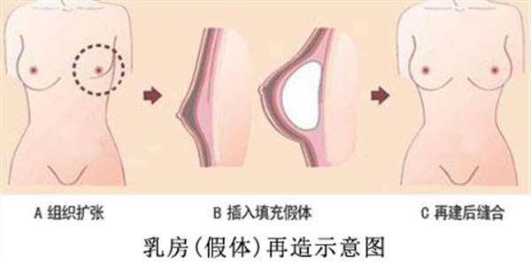 <a href=http://www.sbs17.com/listinfo-620-0.html target=_blank class=infotextkey>乳房再造</a>有副作用嗎