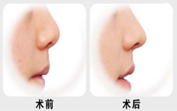 自體肋骨<a href=http://www.sbs17.com/listinfo-737-0.html target=_blank class=infotextkey>隆鼻</a>