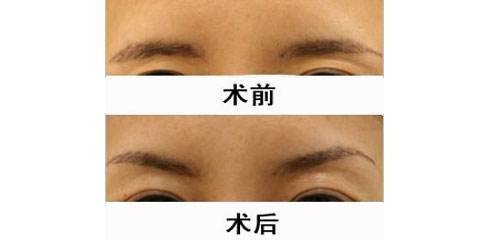 眉弓去薄術(shù)哪里可以做