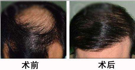   無痕頭發(fā)種植的價(jià)格