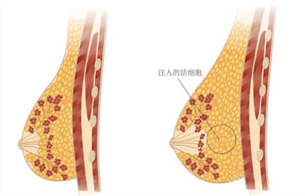 復合<a href=http://www.sbs17.com/listinfo-618-0.html target=_blank class=infotextkey>隆胸</a>的好處