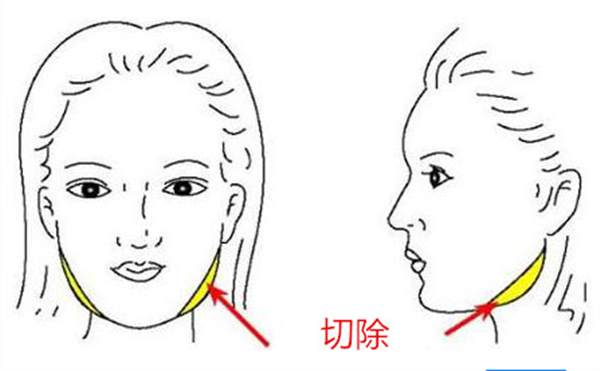切除咬肌多少錢(qián)