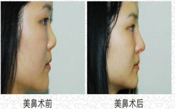 膨體<a href=http://www.sbs17.com/listinfo-737-0.html target=_blank class=infotextkey>隆鼻</a>價格多少錢?