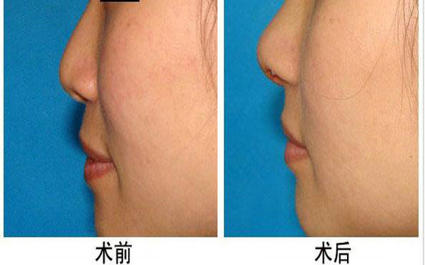 膨體<a href=http://www.sbs17.com/listinfo-737-0.html target=_blank class=infotextkey>隆鼻</a>容易感染嗎?