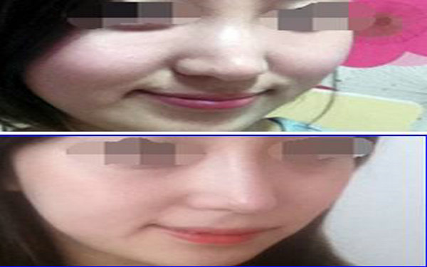 膨體<a href=http://www.sbs17.com/listinfo-737-0.html target=_blank class=infotextkey>隆鼻</a>一般幾年取出?