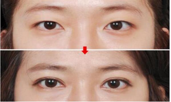 抽脂<a href=http://www.sbs17.com/listinfo-708-0.html target=_blank class=infotextkey>去眼袋</a>術(shù)后效果怎樣