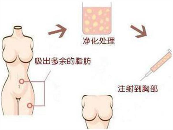 自體脂肪豐胸效果好嗎