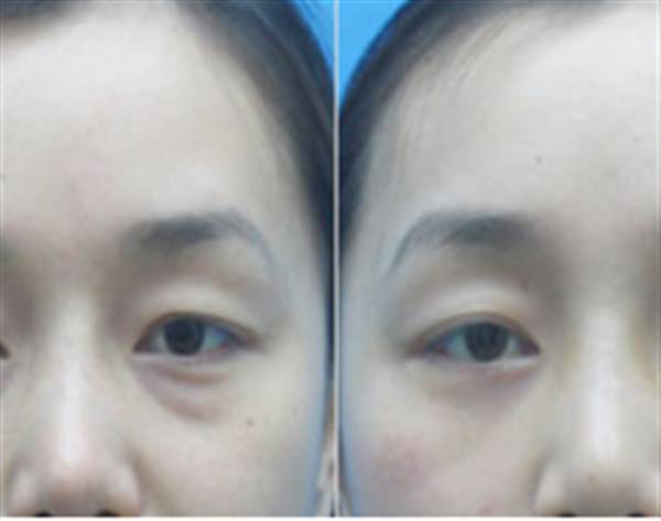 <a href=http://www.sbs17.com/listinfo-682-0.html target=_blank class=infotextkey>溶脂</a><a href=http://www.sbs17.com/listinfo-708-0.html target=_blank class=infotextkey>去眼袋</a>會不會反彈