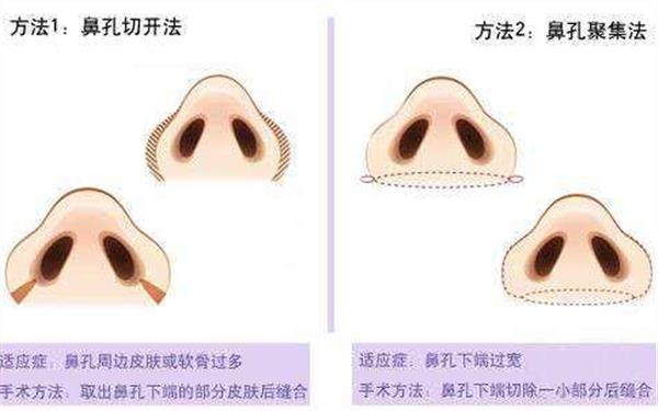 鼻孔縮小<a href=http://www.sbs17.com/listinfo-737-0.html target=_blank class=infotextkey>隆鼻</a>術(shù)的方法有哪些