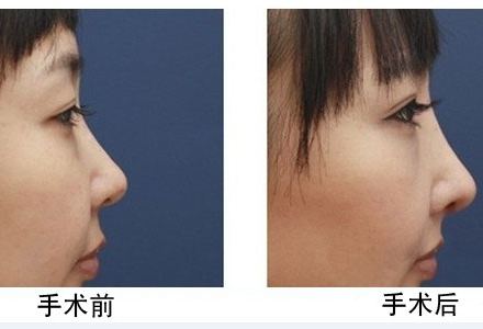 <a href=http://www.sbs17.com/listinfo-737-0.html target=_blank class=infotextkey>隆鼻</a>哪種較安全