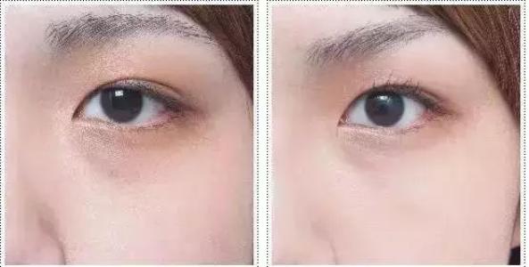 超聲波<a href=http://www.sbs17.com/listinfo-708-0.html target=_blank class=infotextkey>去眼袋</a>安全嗎