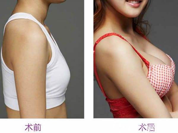 自體脂肪<a href=http://www.sbs17.com/listinfo-618-0.html target=_blank class=infotextkey>隆胸</a>長期的嗎