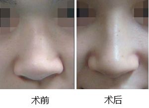 <a href=http://www.sbs17.com/listinfo-737-0.html target=_blank class=infotextkey>隆鼻</a>后多久能消腫