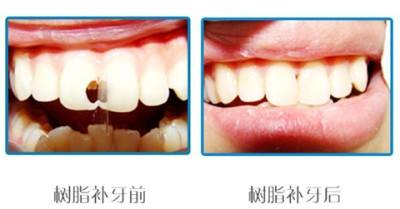 牙齒斷了一半怎么修復(fù)