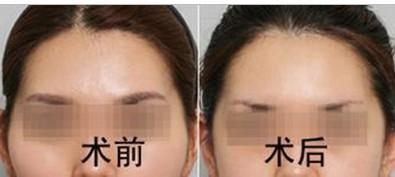 太陽(yáng)凹陷填充圖片對(duì)比
