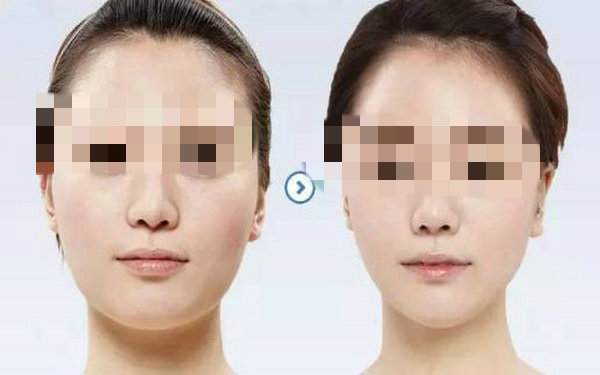 面部激光<a href=http://www.sbs17.com/listinfo-682-0.html target=_blank class=infotextkey>溶脂</a>恢復期