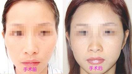 <a href=http://www.sbs17.com/listinfo-690-0.html target=_blank class=infotextkey>自體脂肪填充</a>太陽穴照片