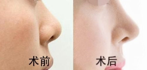 做<a href=http://www.sbs17.com/listinfo-737-0.html target=_blank class=infotextkey>隆鼻</a>手術(shù)有風(fēng)險(xiǎn)嗎