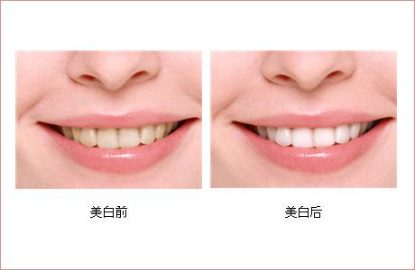 <a href=http://www.sbs17.com/listinfo-828-0.html target=_blank class=infotextkey>牙齒美白</a>的辦法有哪些呢