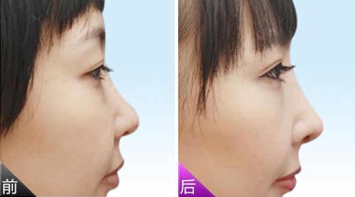 注射<a href=http://www.sbs17.com/listinfo-737-0.html target=_blank class=infotextkey>隆鼻</a>價格貴嗎