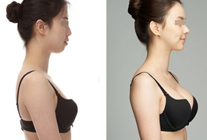  自體健康細胞脂肪<a href=http://www.sbs17.com/listinfo-618-0.html target=_blank class=infotextkey>隆胸</a>