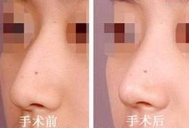 <a href=http://www.sbs17.com/listinfo-756-0.html target=_blank class=infotextkey>駝峰鼻矯正</a>的方式及手術(shù)危害