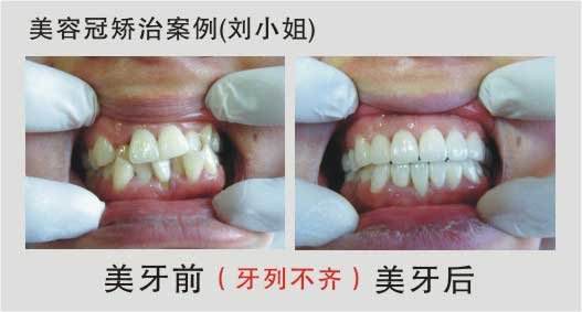 什么是<a href=http://www.sbs17.com/listinfo-830-0.html target=_blank class=infotextkey>美容冠</a>矯正