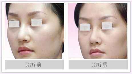 <a href=http://www.sbs17.com/listinfo-753-0.html target=_blank class=infotextkey>鼻頭縮小</a>恢復(fù)