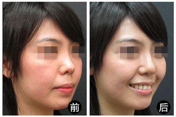 <a href=http://www.sbs17.com/listinfo-737-0.html target=_blank class=infotextkey>隆鼻</a>一般價(jià)位多少