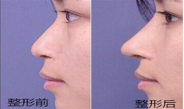 透明質(zhì)酸<a href=http://www.sbs17.com/listinfo-737-0.html target=_blank class=infotextkey>隆鼻</a>后的案例效果圖