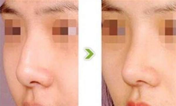 膨體<a href=http://www.sbs17.com/listinfo-737-0.html target=_blank class=infotextkey>隆鼻</a>的一些優(yōu)勢