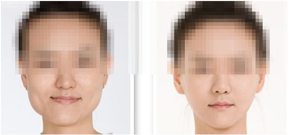 保障<a href=http://www.sbs17.com/listinfo-629-0.html target=_blank class=infotextkey>下頜角</a>整形手術(shù)成功術(shù)前準(zhǔn)備十分必要