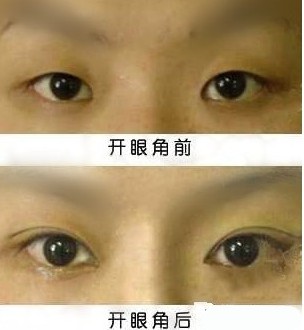 <a href=http://www.sbs17.com/listinfo-711-0.html target=_blank class=infotextkey>開眼角</a>手術修復哪里好