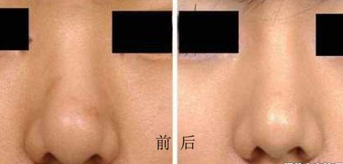  鼻頭圓大怎么縮小