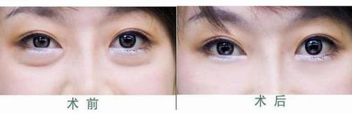 做外切眼袋多久能恢復(fù)