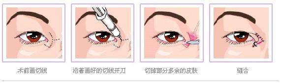 <a href=http://www.sbs17.com/listinfo-711-0.html target=_blank class=infotextkey>開眼角</a>多久才能恢復