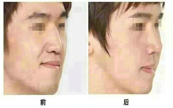 面部光纖<a href=http://www.sbs17.com/listinfo-682-0.html target=_blank class=infotextkey>溶脂</a>會(huì)反彈嗎?