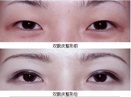 割<a href=http://www.sbs17.com/listinfo-724-0.html target=_blank class=infotextkey>雙眼皮</a>抽脂疼嗎