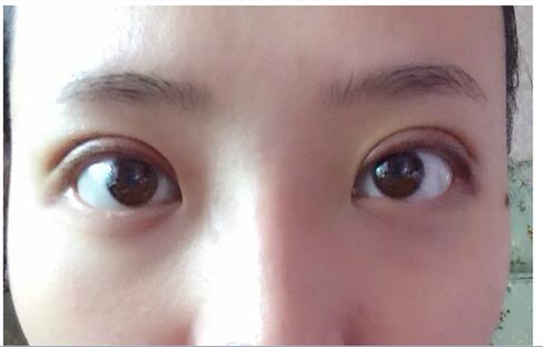 埋線<a href=http://www.sbs17.com/listinfo-724-0.html target=_blank class=infotextkey>雙眼皮</a>前列天照片