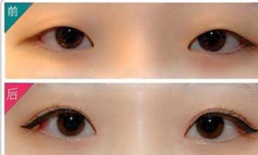 埋線法割<a href=http://www.sbs17.com/listinfo-724-0.html target=_blank class=infotextkey>雙眼皮</a>原理