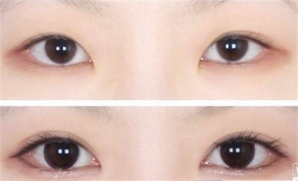 埋線法做<a href=http://www.sbs17.com/listinfo-724-0.html target=_blank class=infotextkey>雙眼皮</a>多少錢
