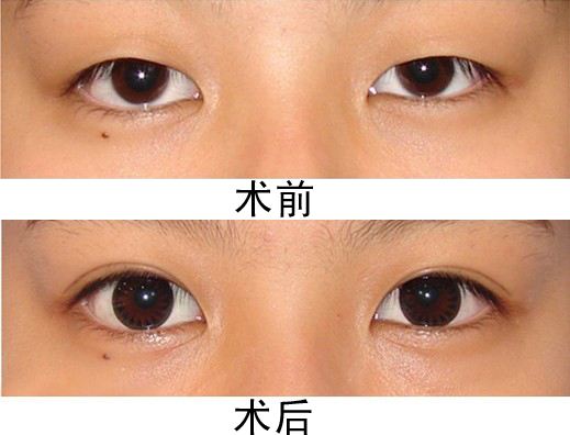廣州做<a href=http://www.sbs17.com/listinfo-724-0.html target=_blank class=infotextkey>雙眼皮</a>多少錢