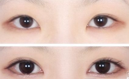 割<a href=http://www.sbs17.com/listinfo-724-0.html target=_blank class=infotextkey>雙眼皮</a>后幾天拆線