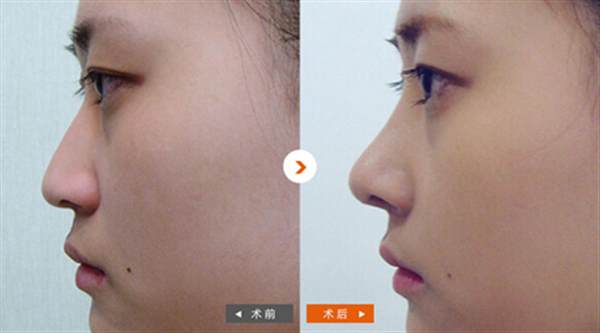 注射<a href=http://www.sbs17.com/listinfo-737-0.html target=_blank class=infotextkey>隆鼻</a>的副作用