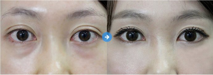 鐳射<a href=http://www.sbs17.com/listinfo-708-0.html target=_blank class=infotextkey>去眼袋</a>有風(fēng)險(xiǎn)嗎