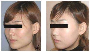 做<a href=http://www.sbs17.com/listinfo-629-0.html target=_blank class=infotextkey>下頜角</a>整形手術(shù)術(shù)后注意哪些呢