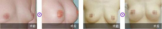 下垂能恢復(fù)嗎