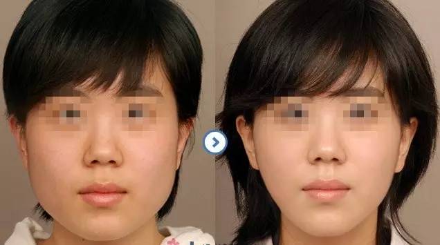 緊膚美容手術(shù)效果好嗎