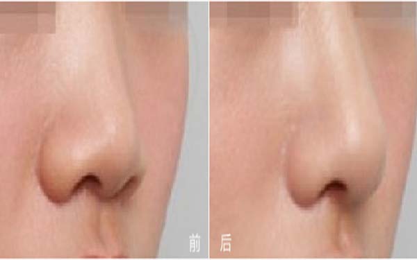 硅膠墊價格是多少